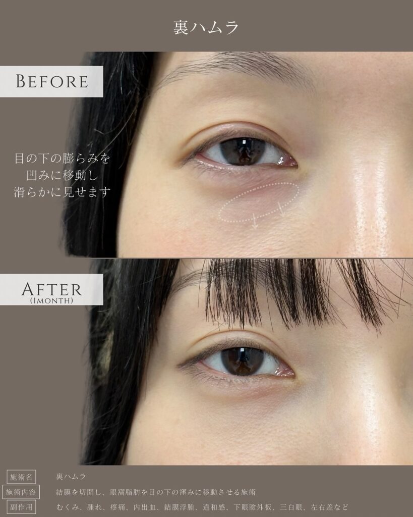 裏ハムラ法の症例写真 (50)