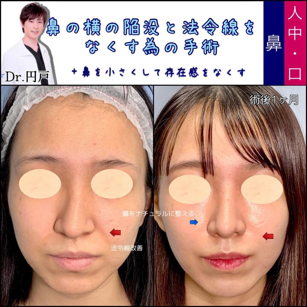 貴族手術の症例写真 (5)