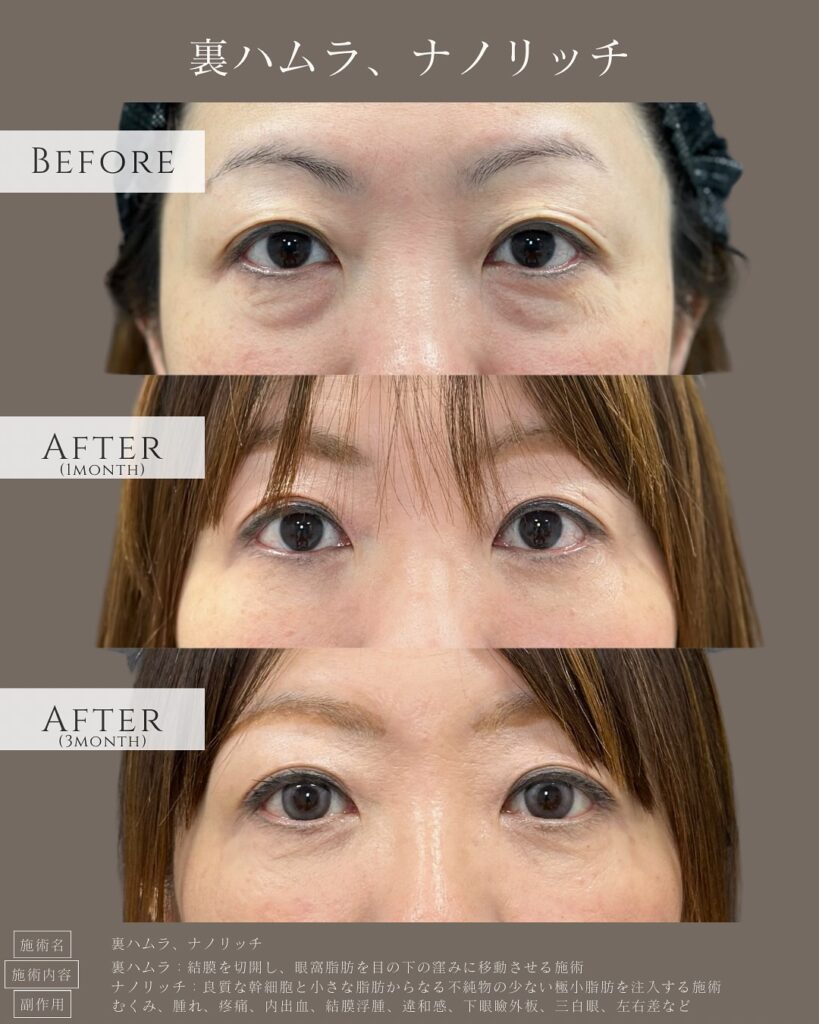 裏ハムラ法とナノリッチの症例写真 (6)