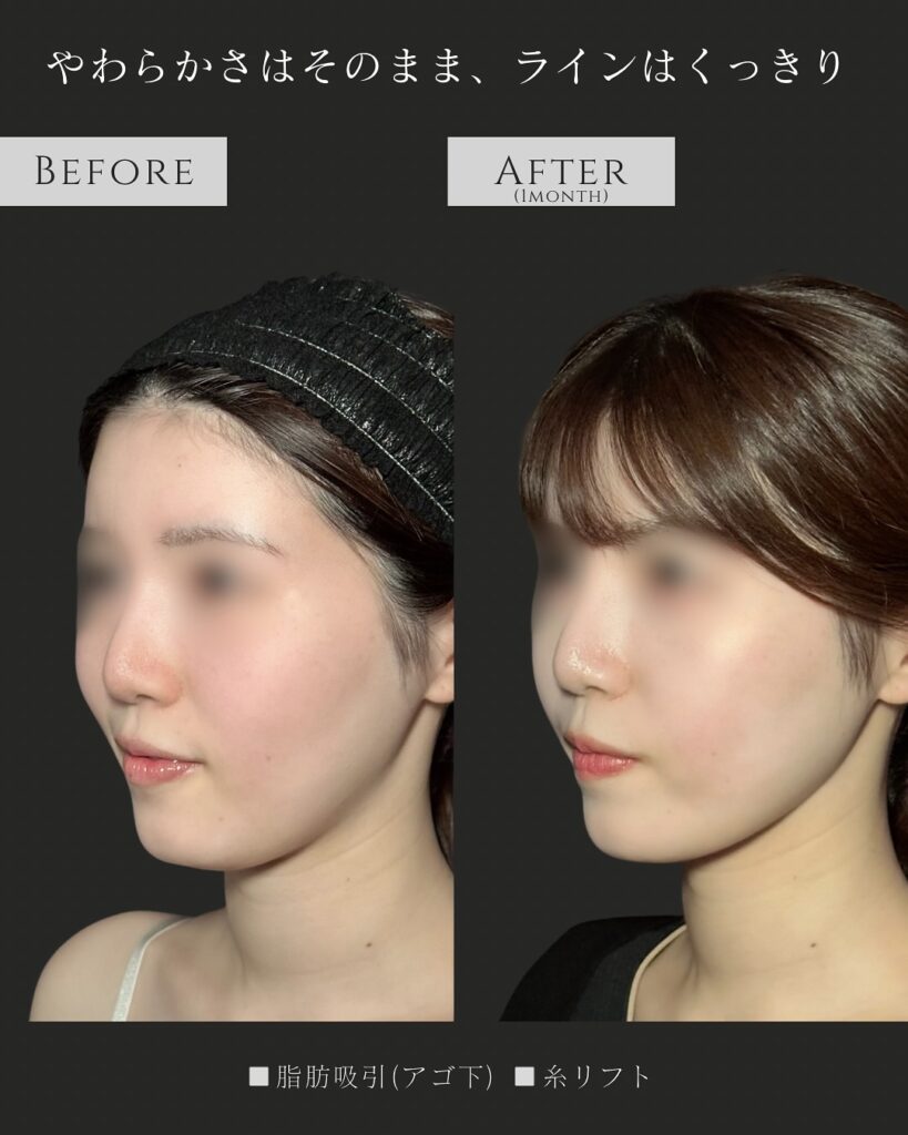 顎下の脂肪吸引と糸リフトの症例写真 (7)