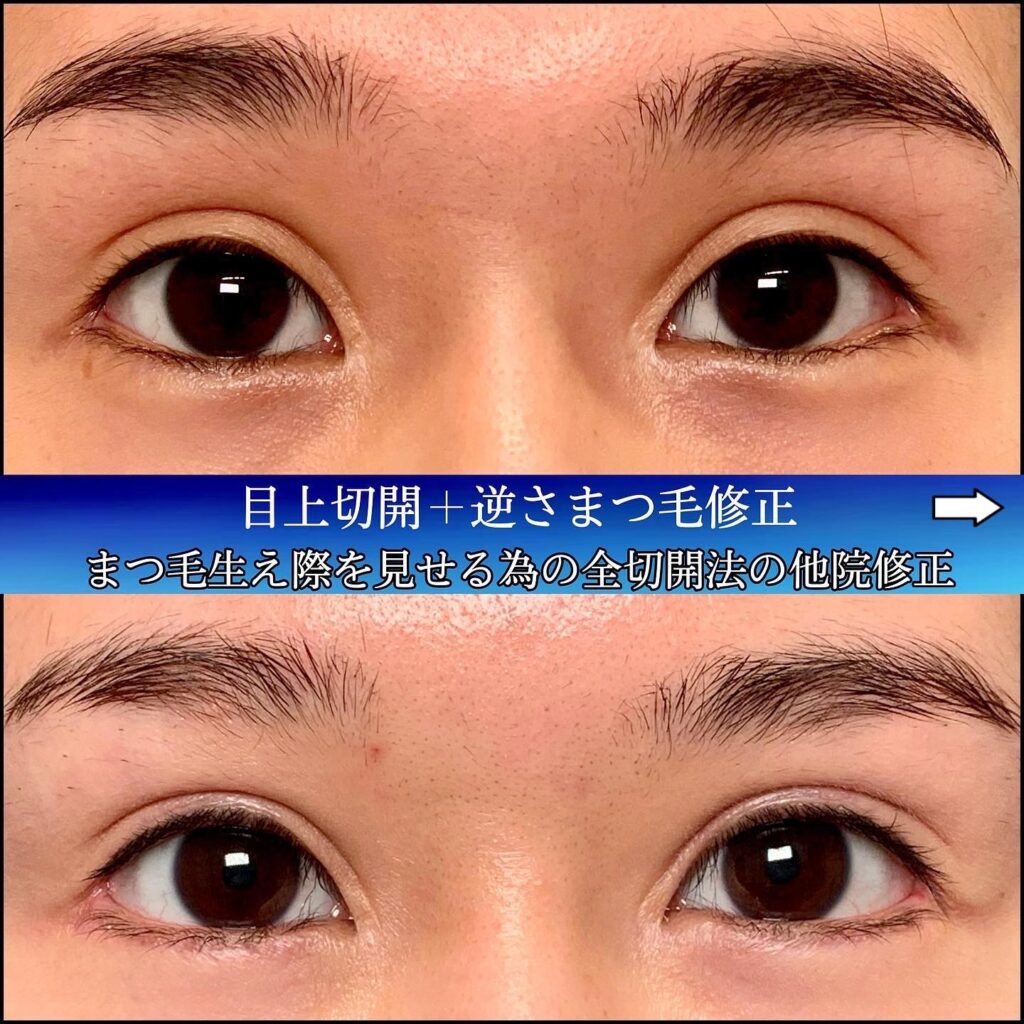 全切開の他院修正と下瞼拡大と逆さまつげ修正の症例写真 (1)