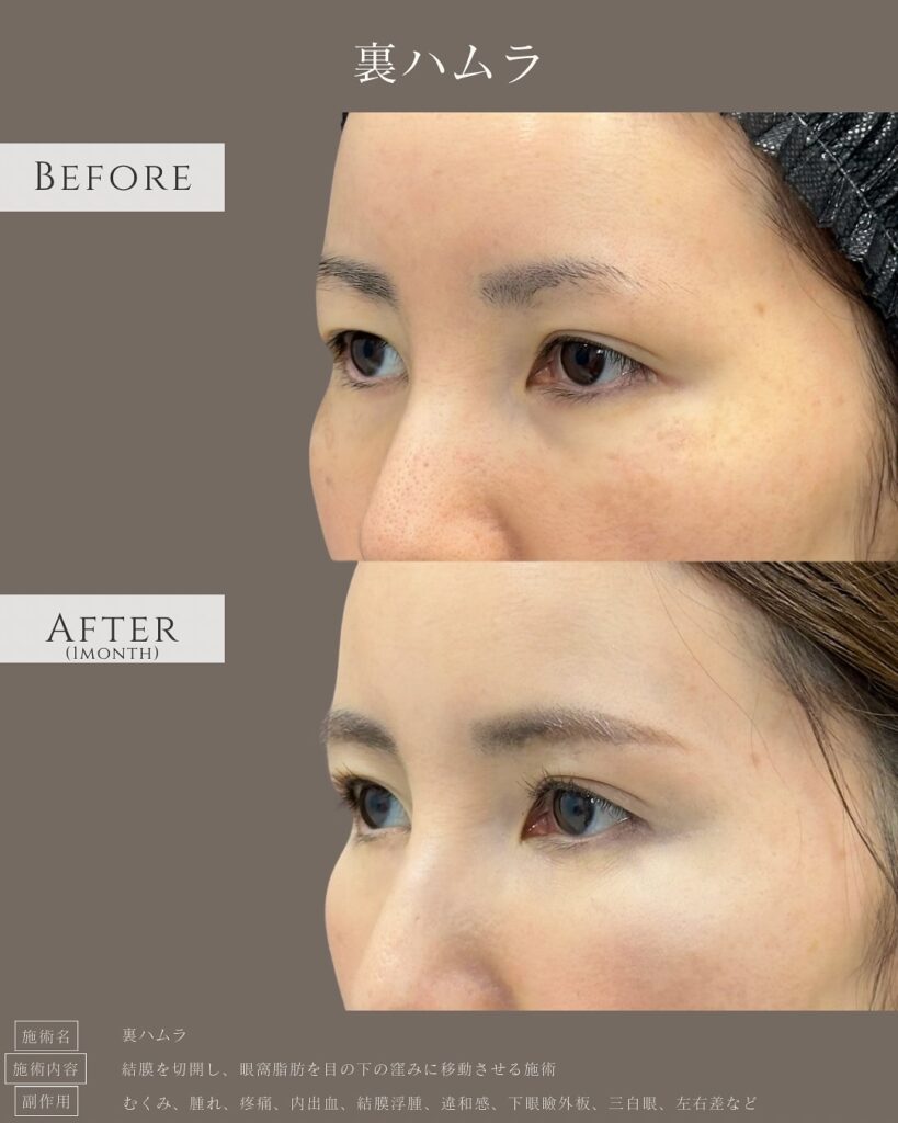 裏ハムラ法の症例写真 (12)