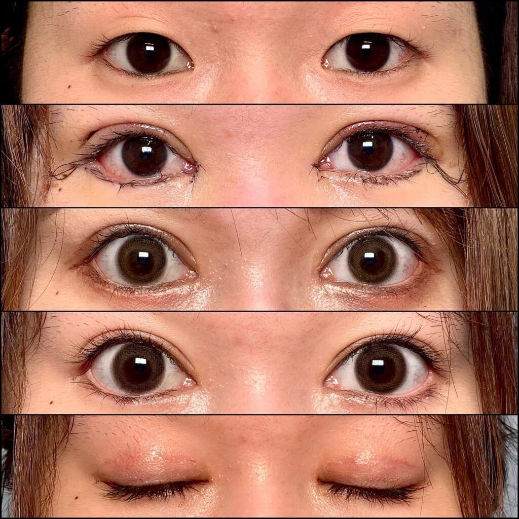 眼瞼下垂と全切開と目尻切開とタレ目形成と目尻切開の症例写真 (2)