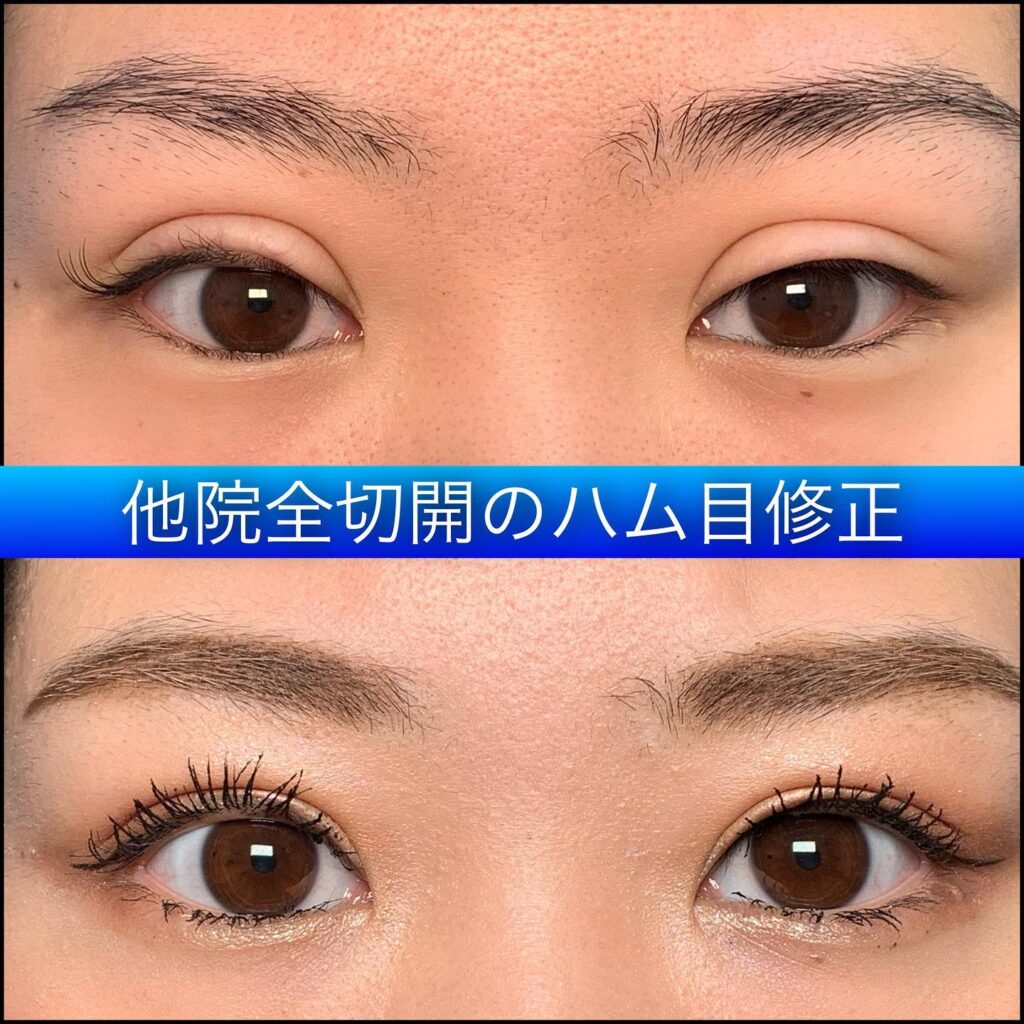 他院全切開のハム目修正 (1)