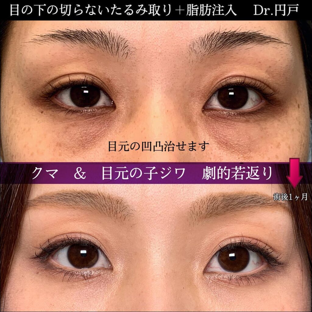 目の下の切らないたるみ取りと脂肪注入の症例写真 (2)