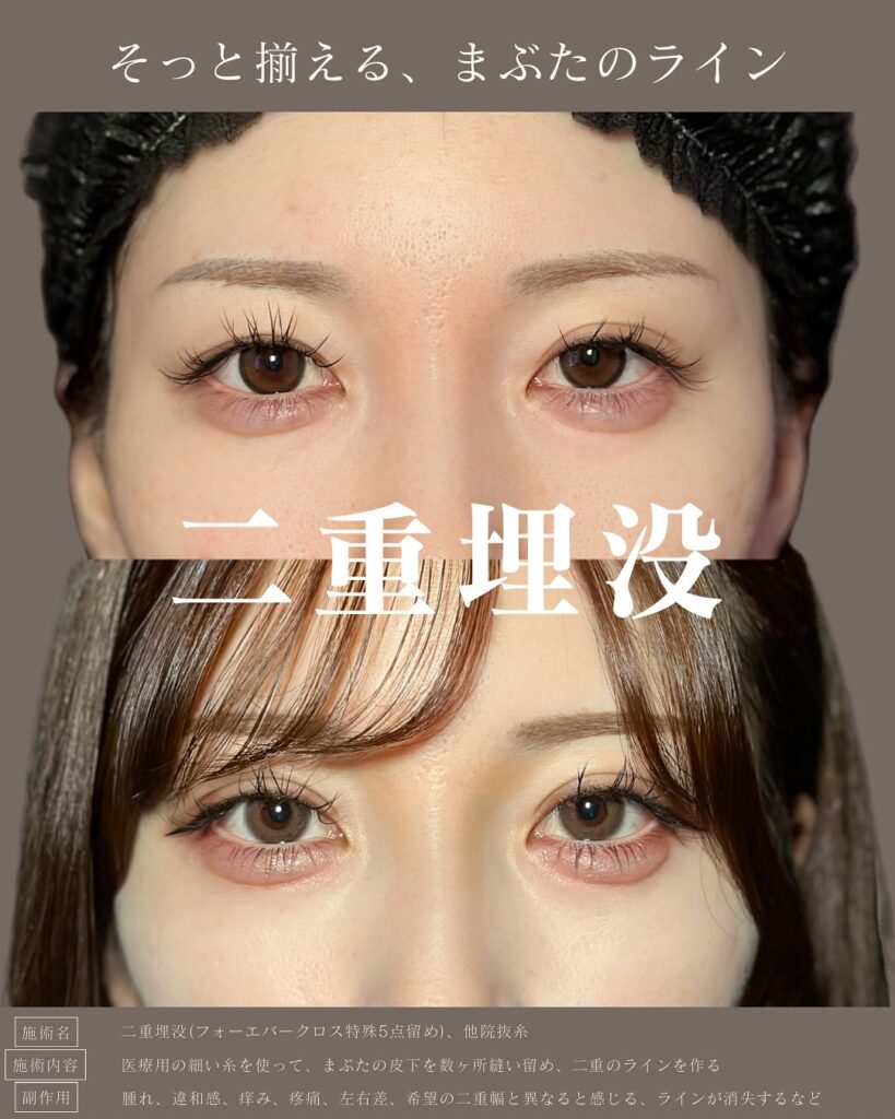 埋没法と他院の抜糸の症例写真 (1)