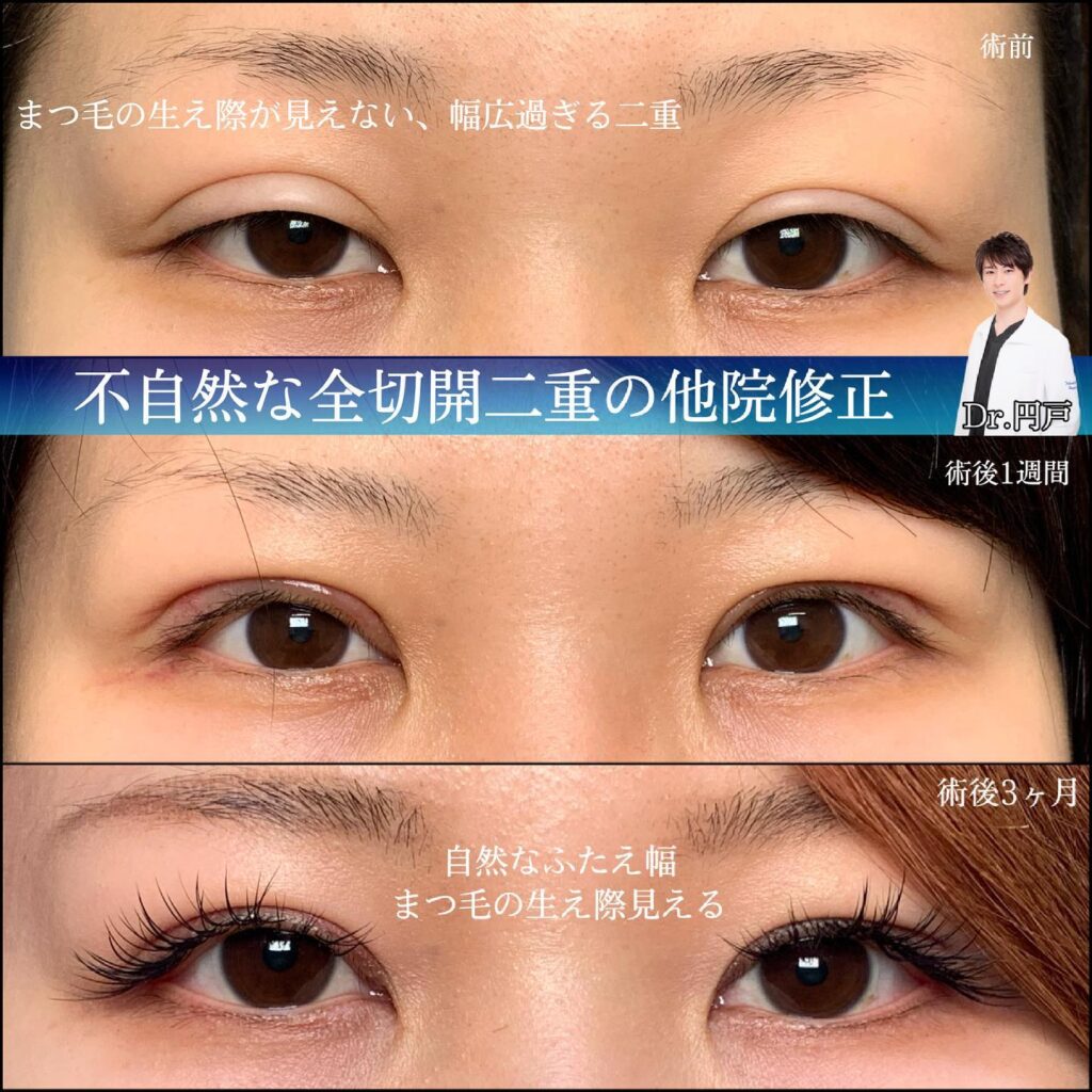 全切開二重の他院修正の症例写真