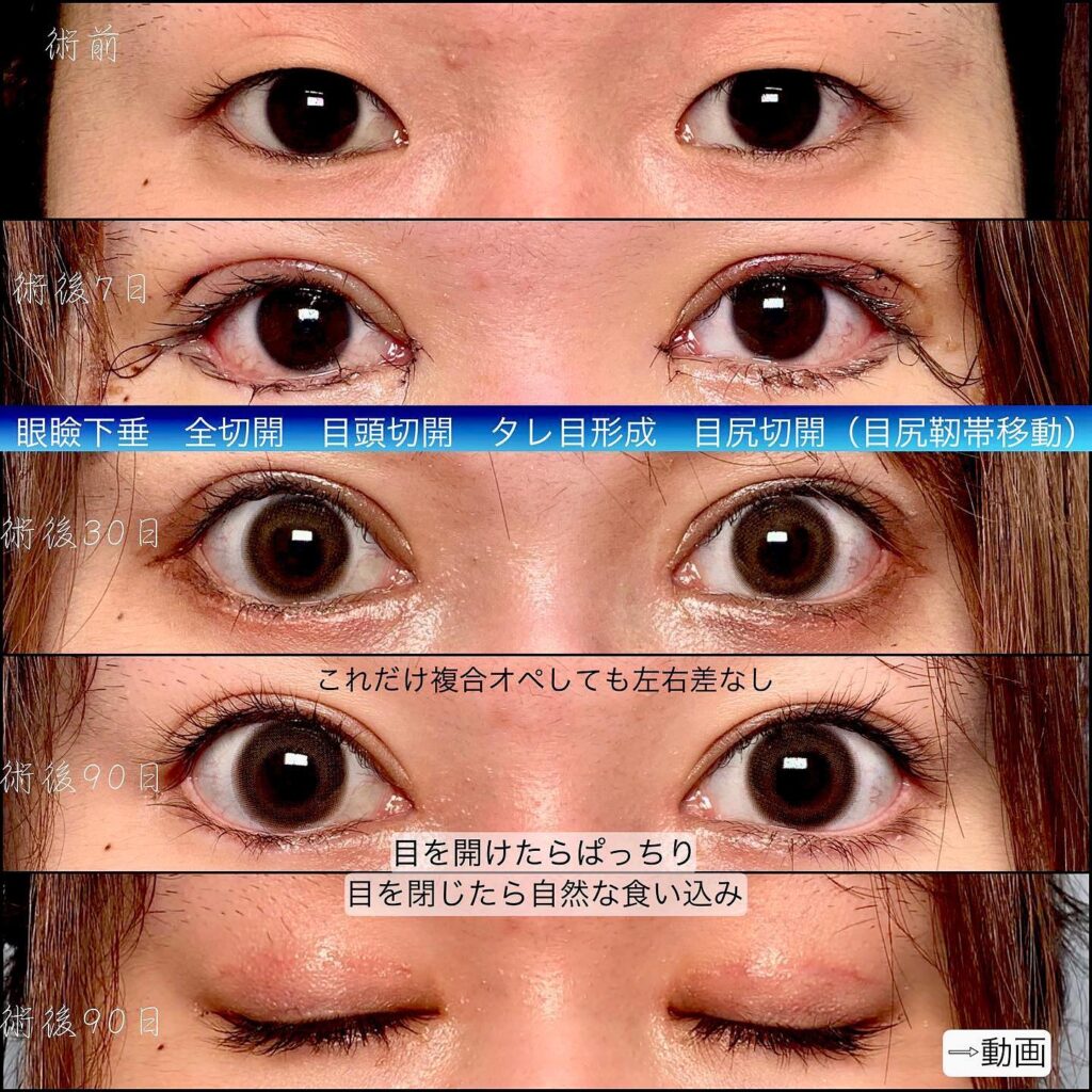眼瞼下垂と全切開と目頭切開とタレ目形成と目尻切開の症例写真
