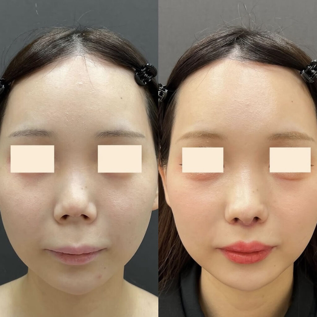 ４回目の肋軟骨の修正手術の正面の症例写真