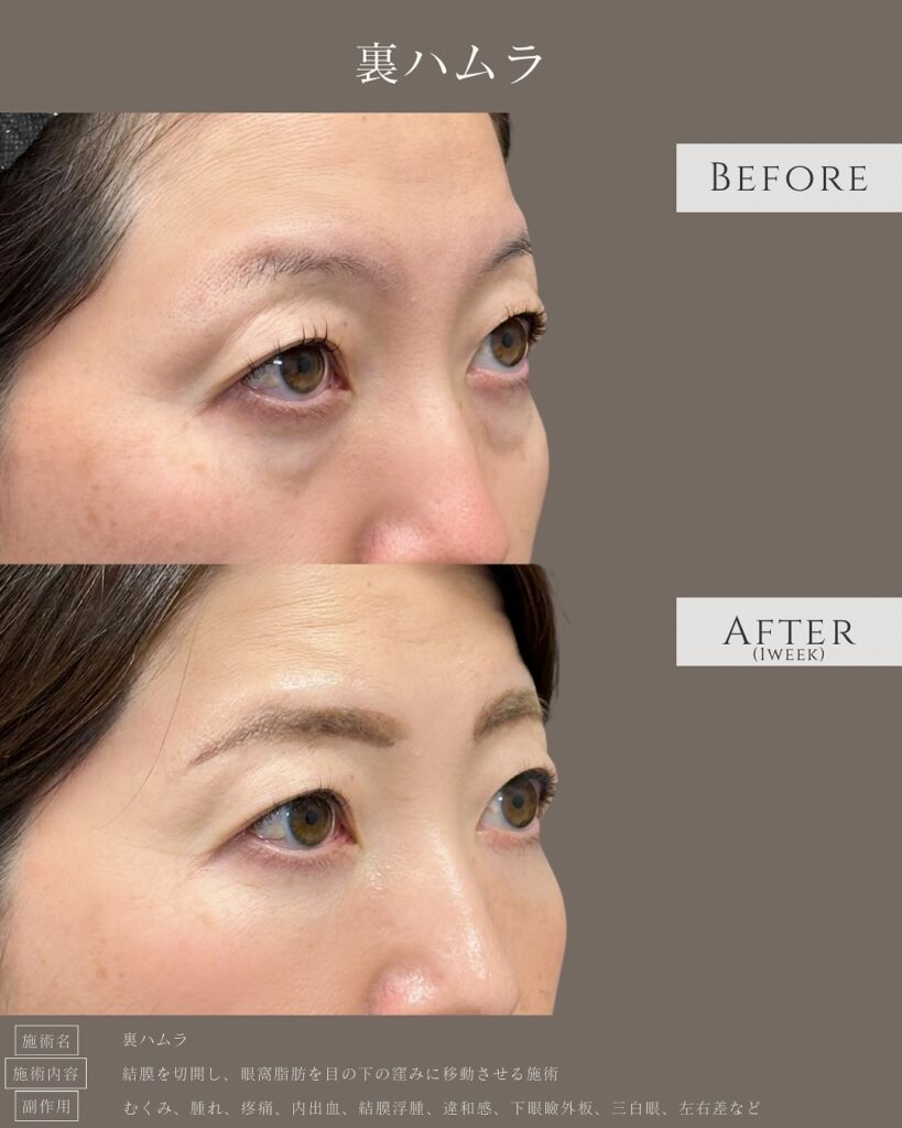 裏ハムラ法の症例写真 (32)