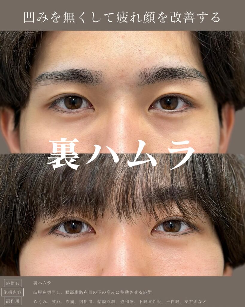 裏ハムラ法を受けた男性の症例写真 (4)