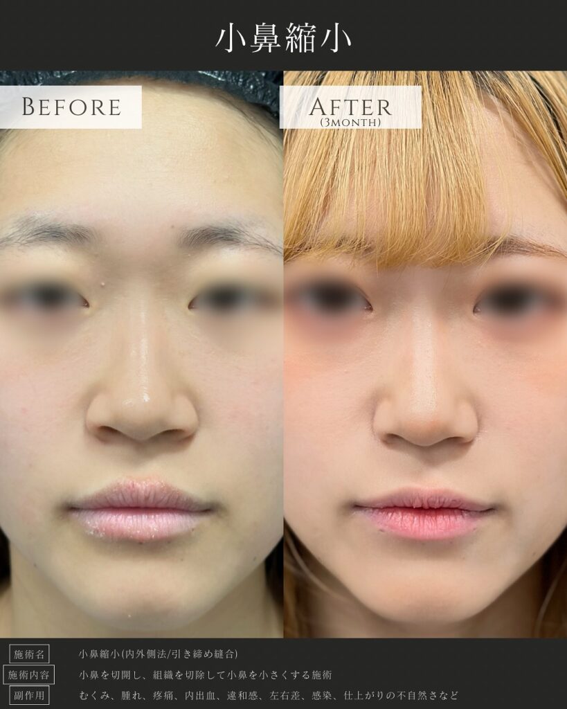小鼻縮小の症例写真 (4)