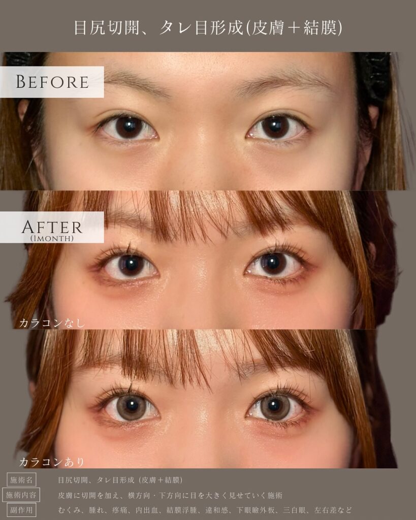目尻切開とタレ目形成の症例写真 (21)