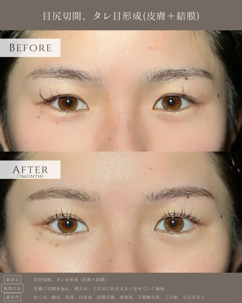 目尻切開とタレ目形成の症例写真 (17)