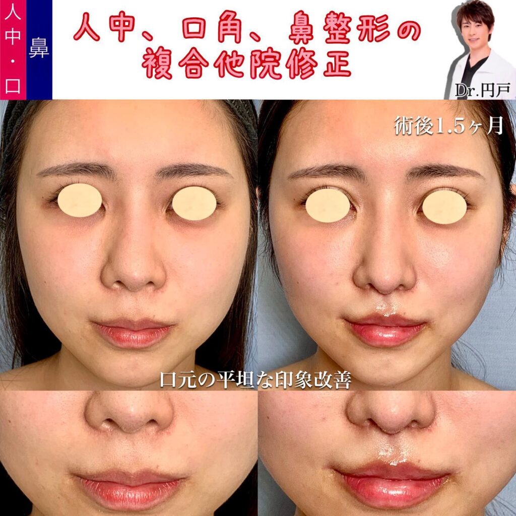 人中と口角と鼻整形の症例写真