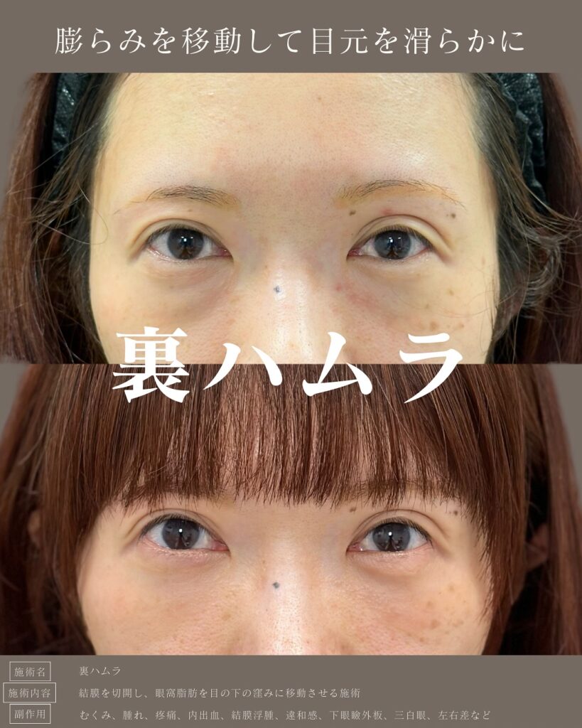 裏ハムラ法の症例写真 (43)