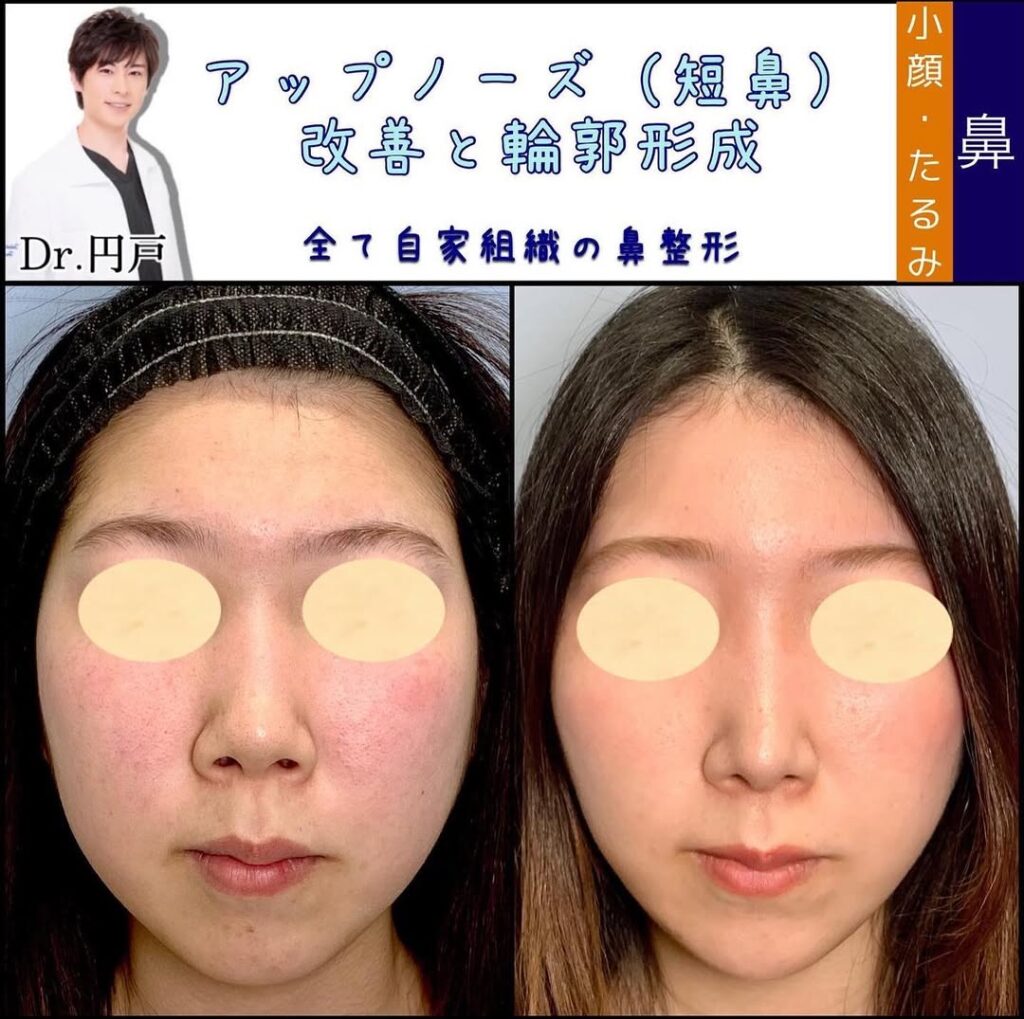 鼻中隔延長と鼻背部軟骨移植と鼻尖形成と軟骨移植と輪郭形成と顎のヒアルロン酸の症例写真 (3)