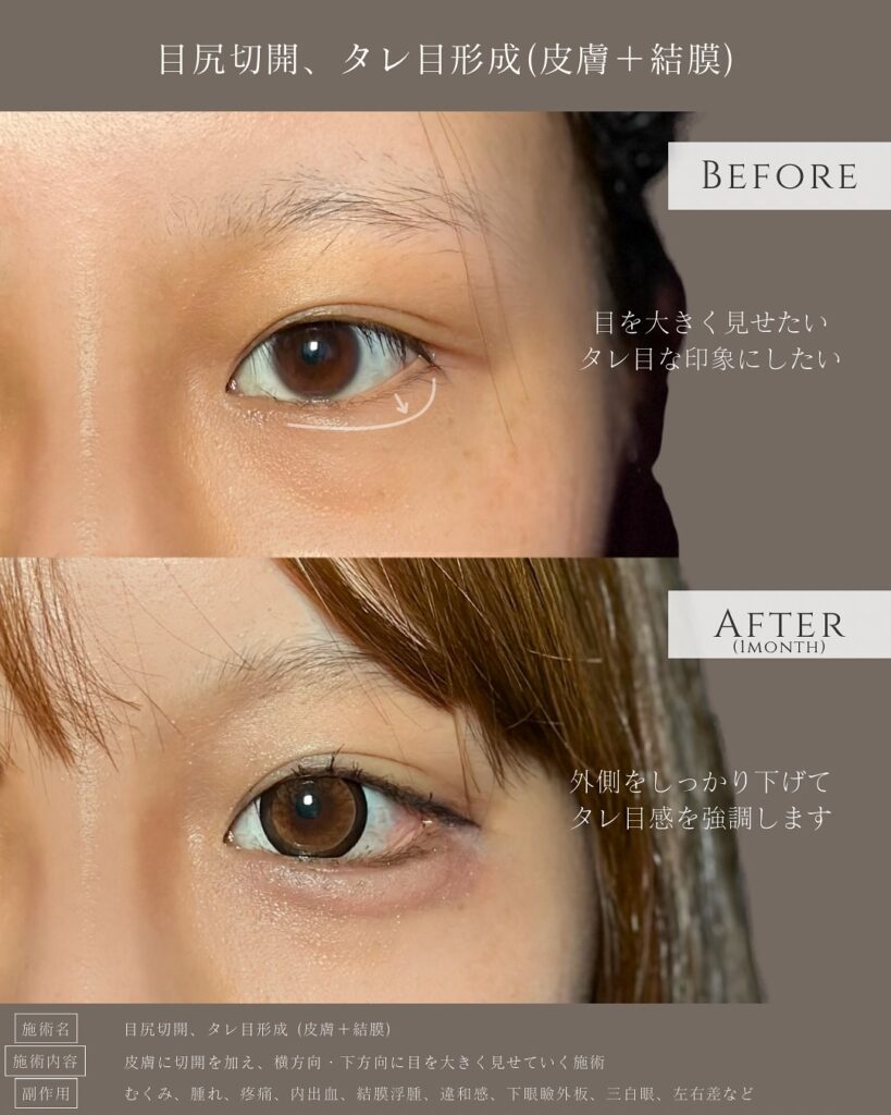 目尻切開とタレ目形成の症例写真 (10)