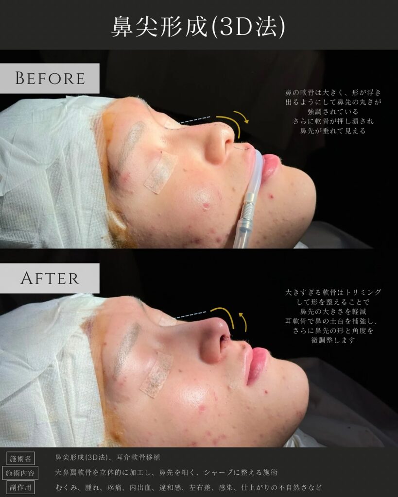 鼻尖形成と耳介軟骨移植の症例写真 (9)