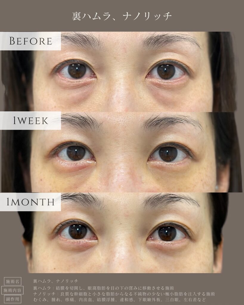 裏ハムラ法とナノリッチの症例写真 (22)