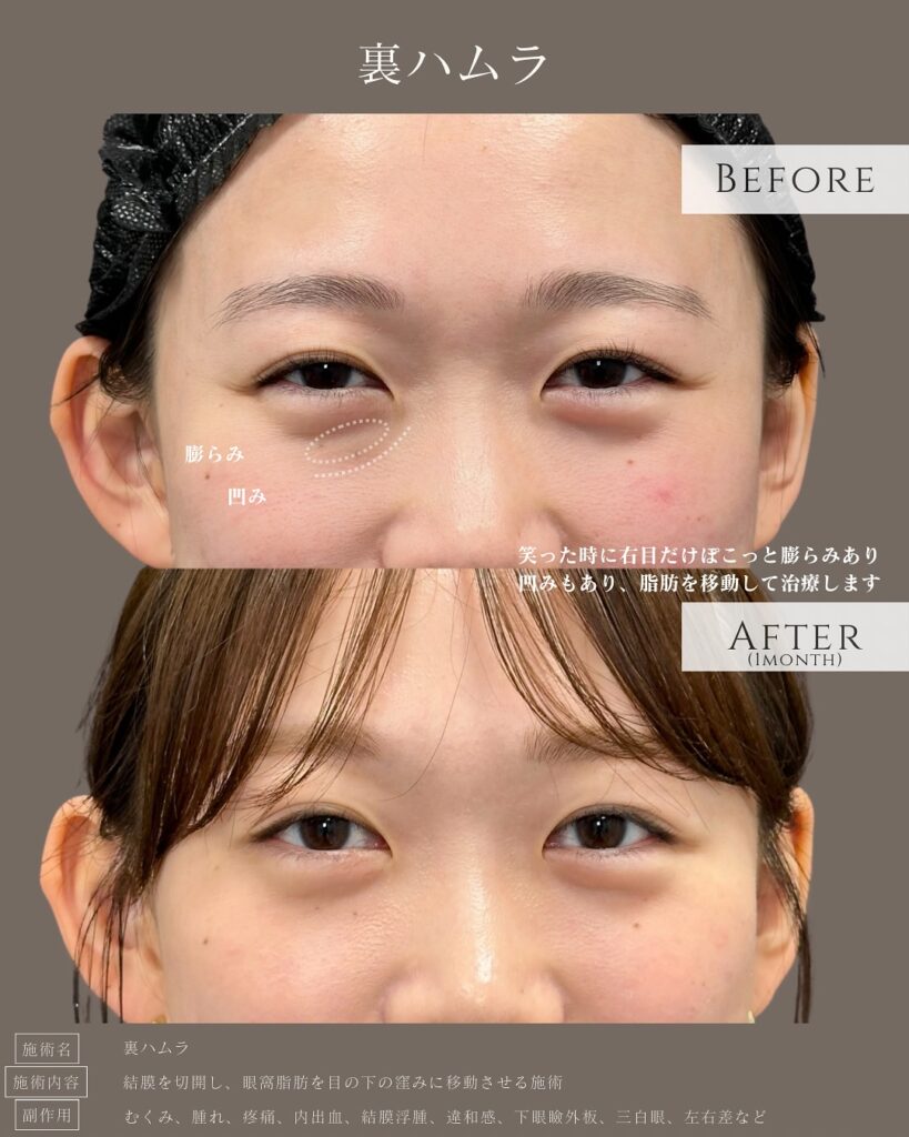 裏ハムラ法の症例写真 (27)