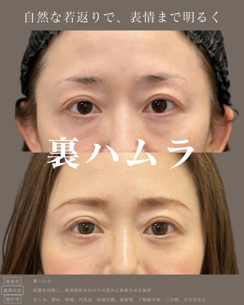 裏ハムラ法の症例写真 (7)