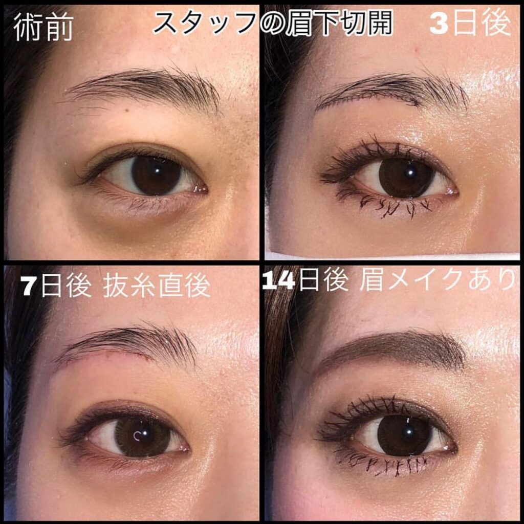 眉下切開+ROOF除去と全切開と眼瞼下垂の症例写真 (2)