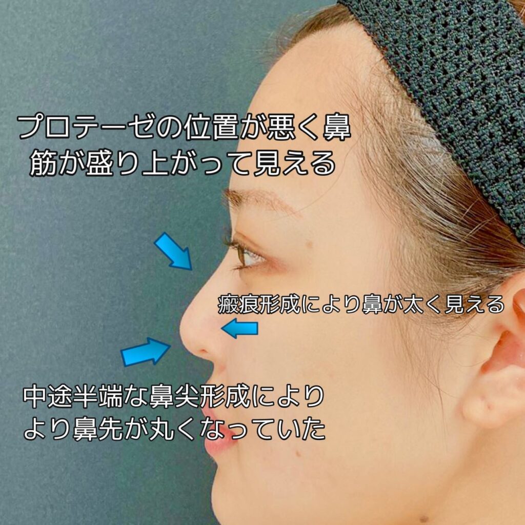 小顔と鼻の他院修正の症例写真 (2)