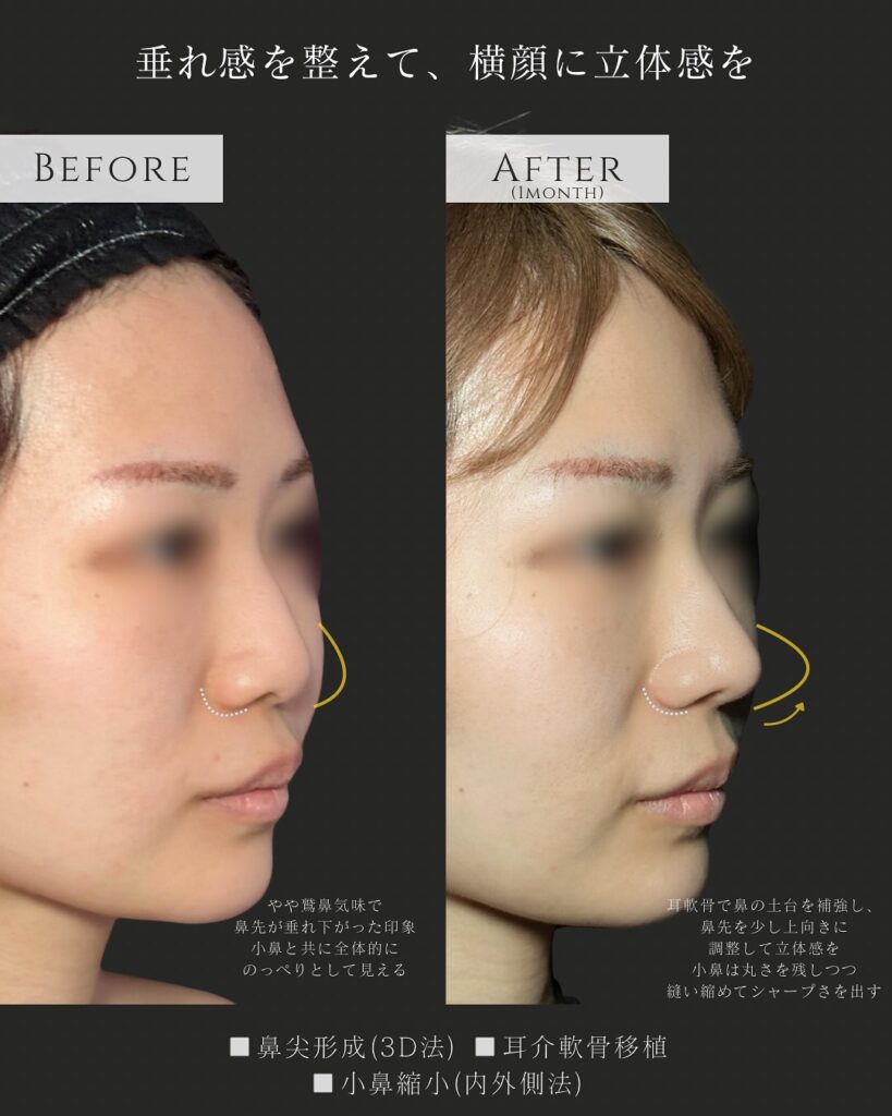 鼻尖形成と耳介軟骨い移植と小鼻縮小の症例写真 (4)
