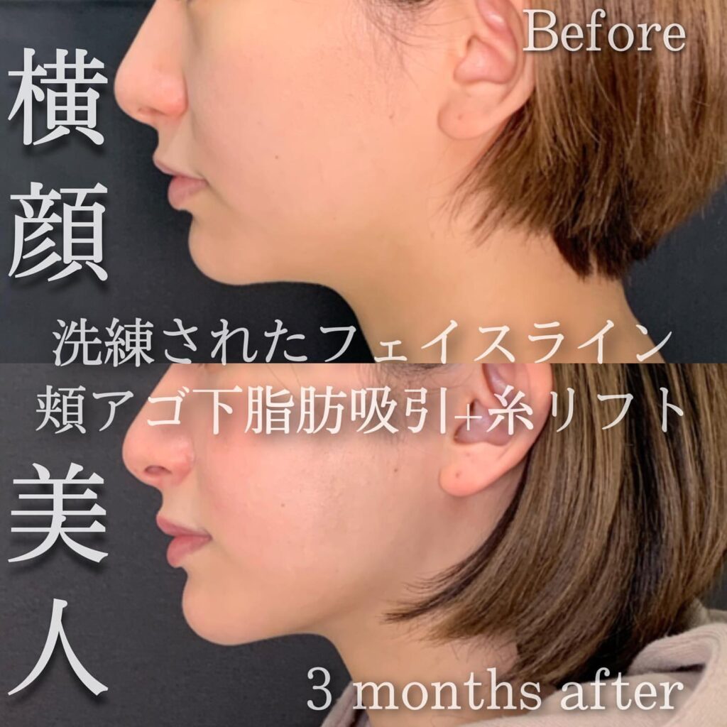 顎下の脂肪吸引と糸リフトの症例写真