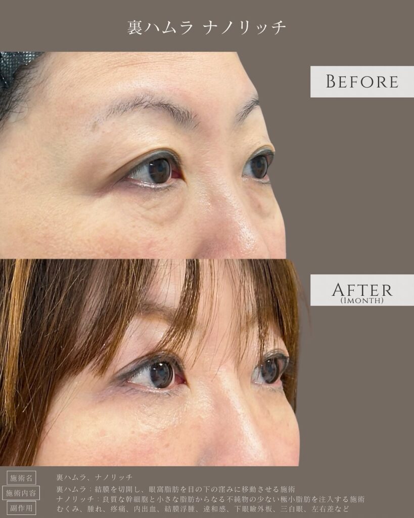 裏ハムラ法とナノリッチの症例写真 (17)