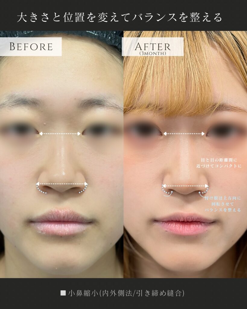 小鼻縮小の症例写真 (6)