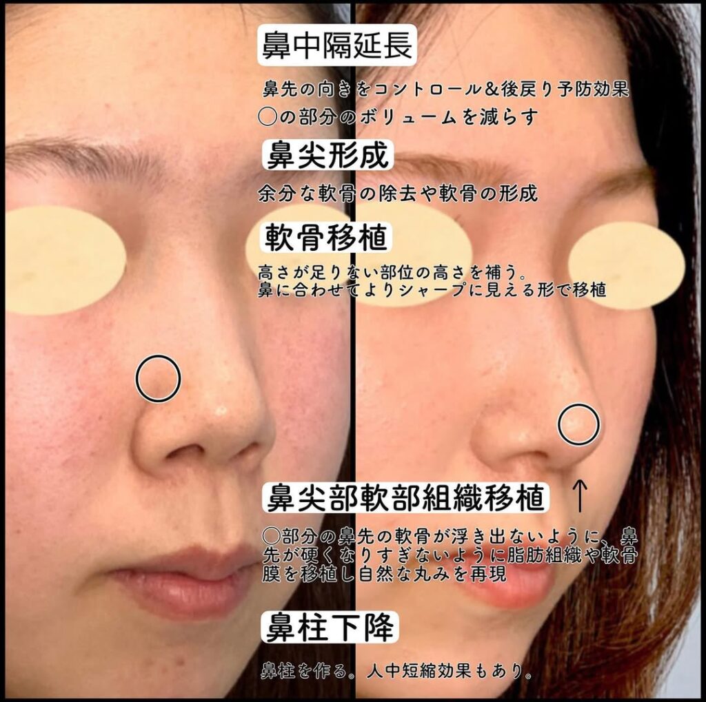 鼻中隔延長と鼻背部軟骨移植と鼻尖形成と軟骨移植と輪郭形成と顎のヒアルロン酸の症例写真 (3)