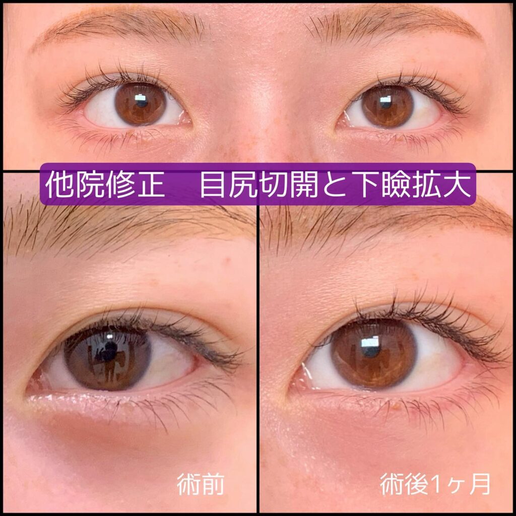 目尻切開と下瞼拡大の症例写真 (1)