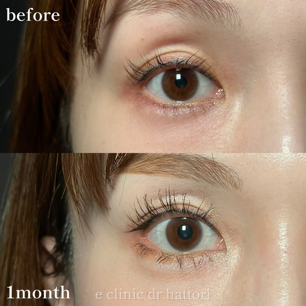 目尻切開とタレ目形成の症例写真 (51)