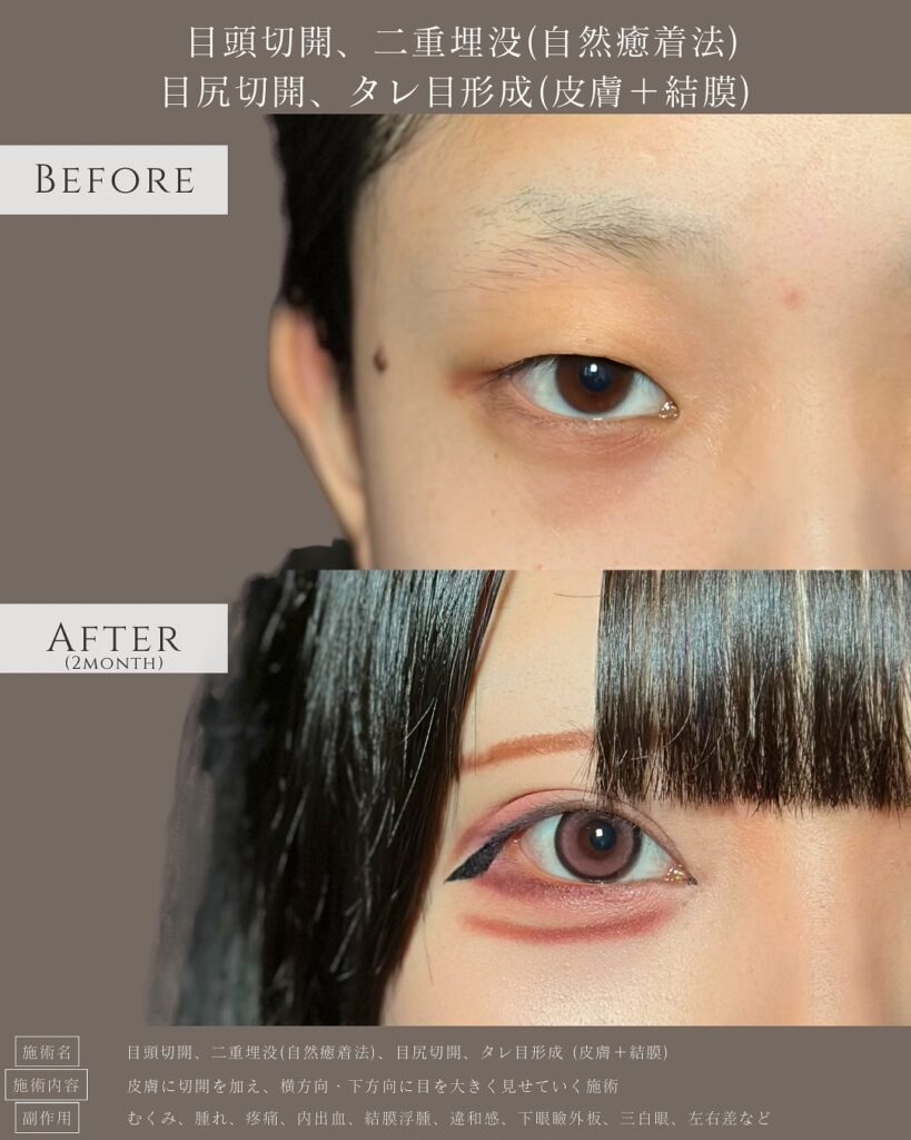 目頭切開と埋没法と目尻切開とタレ目形成の症例写真 (4)