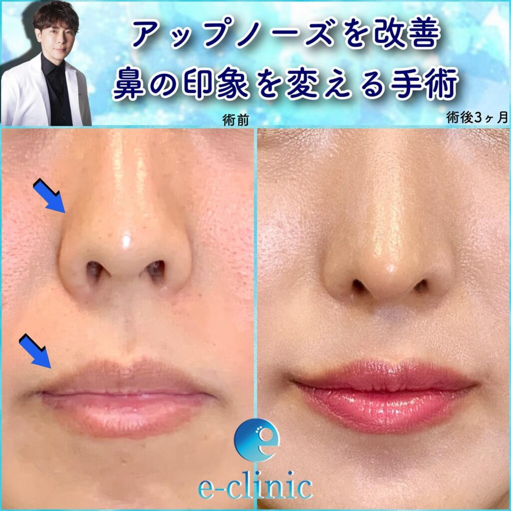 鼻尖形成と軟骨移植と鼻中隔延長と口角挙上と顎のヒアルロン酸の症例写真 (2)