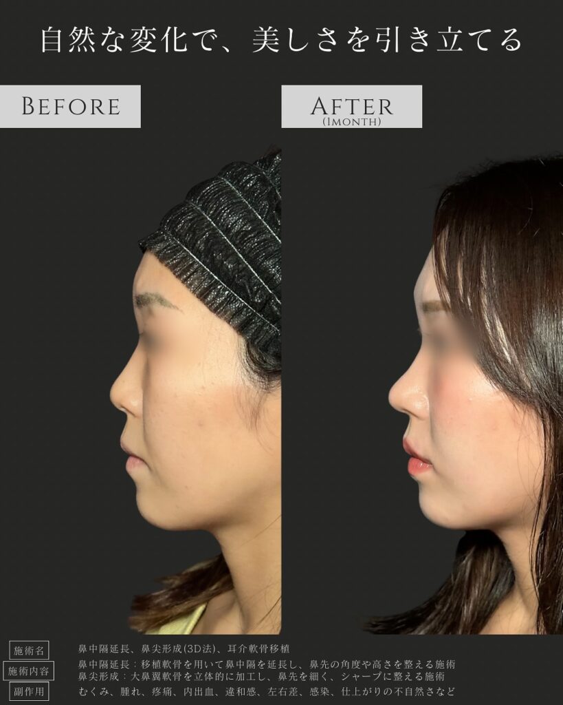 鼻中隔延長と鼻尖形成と耳介軟骨移植の症例写真 (6)