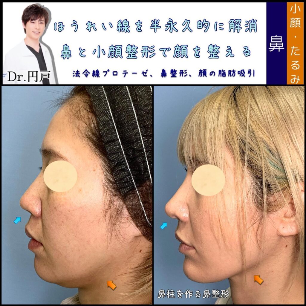 貴族手術と小顔脂肪吸引の症例写真