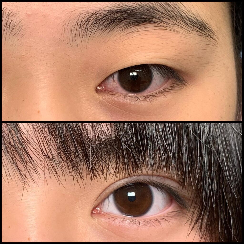 埋没法の症例写真 (15)