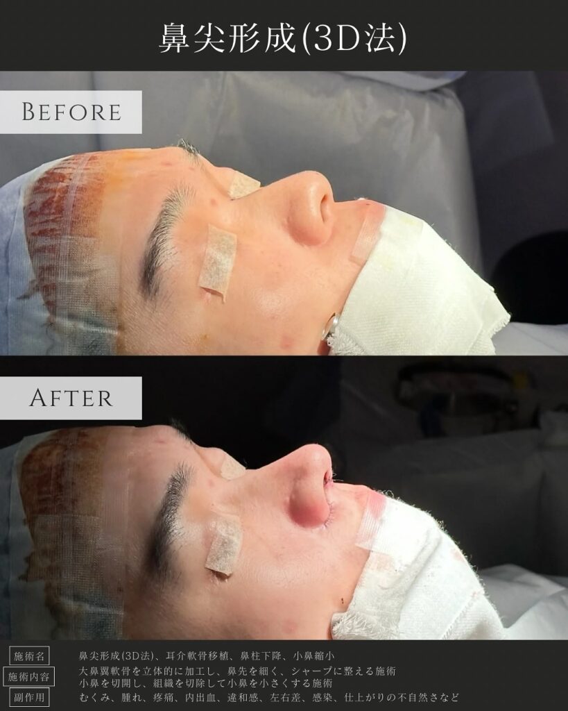 鼻尖形成と耳介軟骨移植と鼻柱下降と小鼻縮小の症例写真 (1)
