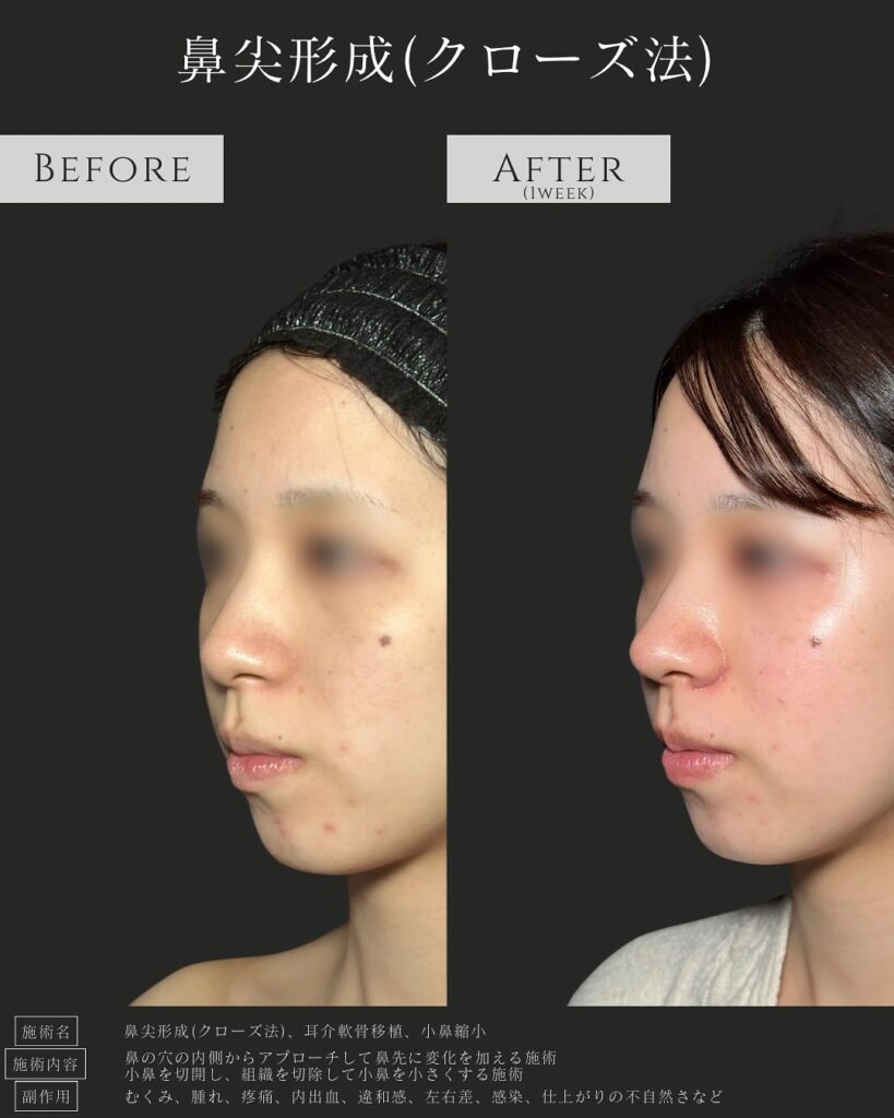 鼻尖形成と耳介軟骨移植と小鼻縮小の症例写真 (1)