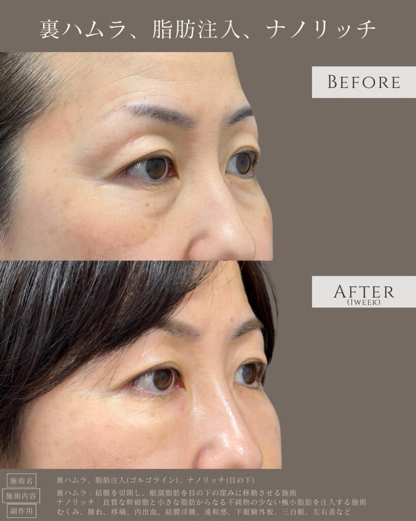 裏ハムラ法とナノリッチの症例写真 (13)