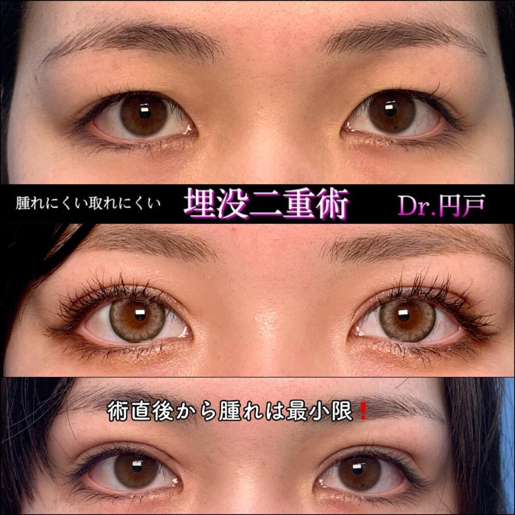 埋没法の症例写真 (14)