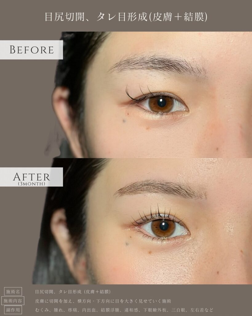 目尻切開とタレ目形成の症例写真 (19)