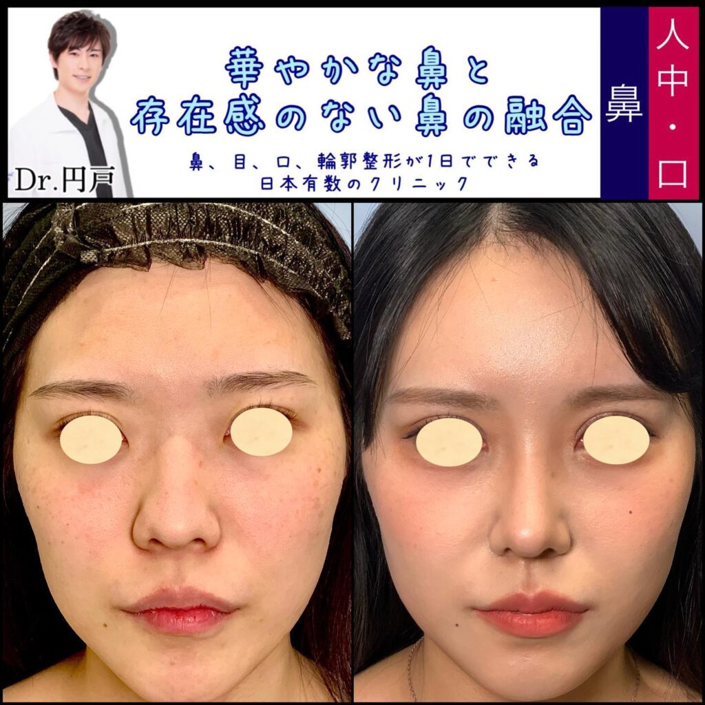 鼻中隔延長と軟骨移植とプロテーゼと脂肪注入と輪郭形成の症例写真 (2)