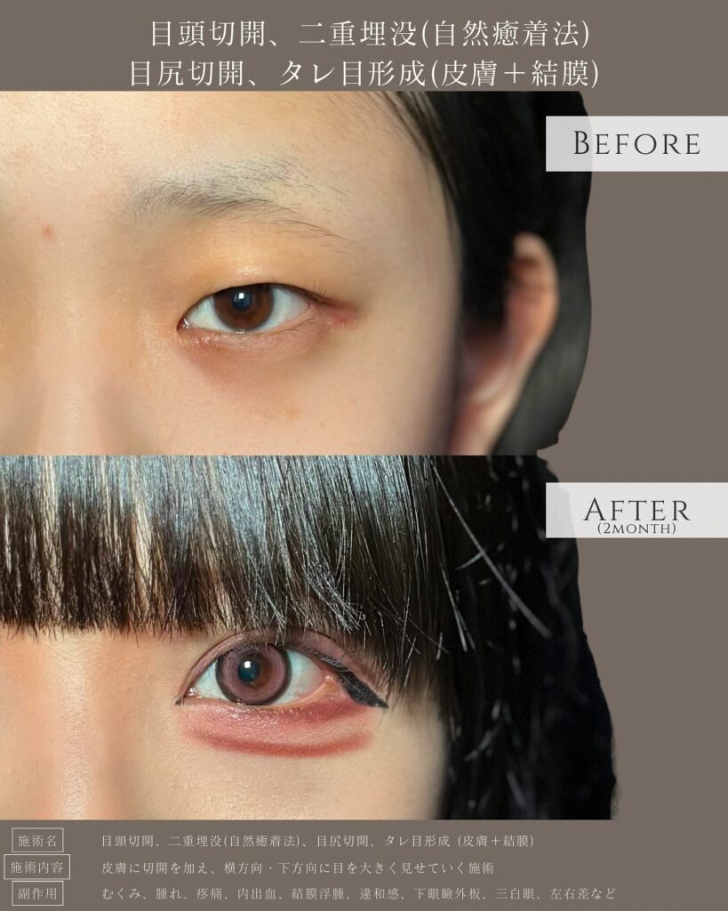 目頭切開と埋没法と目尻切開とタレ目形成の症例写真 (5)