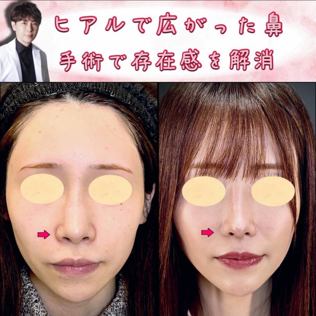 鼻尖形成と軟骨移植と鼻中隔延長とプロテーゼと小鼻縮小とヒアルロン酸溶解注射の症例写真 (3)