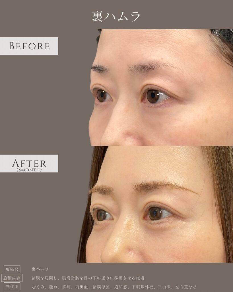 裏ハムラ法の症例写真 (9)