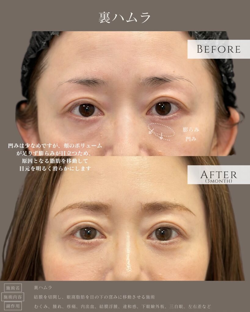 裏ハムラ法の症例写真 (10)